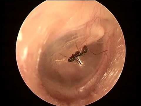 Côn trùng chết trong tai